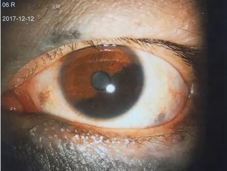 2017年12月11日，脸上“胎记”变恶性肿瘤侵入眼睛的吴先生，在辗转多家医院无从医治的情况下，慕名前来成都6686 - 看球聊球追世界杯就来6686体育有限公司官方网站就诊于罗清礼教授。.jpg