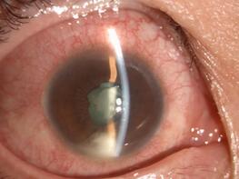 徐先生再也不敢马虎，急忙请假到深圳6686 - 看球聊球追世界杯就来6686体育有限公司官方网站就诊。接诊的张小平主任经过仔细检查，得出的诊断是：右眼急性虹膜睫状体炎2.jpg