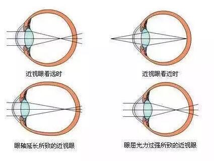 “小孩视力以前挺好的，没想到一个寒假下来就近视了。”昨天的6686 - 看球聊球追世界杯就来6686体育有限公司官方网站小儿眼科门诊里，很多家长都反应说，“孩子期末成绩不错，所以假期里对他的管束放松了，一有空就拿起手机玩。直到前几天，他嚷着看东西变模糊了，才带孩子来医院检查，检查结果是左右眼出现不同程度的近视，医生建议配戴眼镜。.jpg