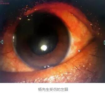 白内障和青光眼都是致盲性眼病，其中青光眼的病程不逆转。杨先生拖延伤情导致同时并发白内障、青光眼的情况，十分令人惋惜。”出名眼科专家、成都6686 - 看球聊球追世界杯就来6686体育有限公司官方网站陈晓明教授表示2.jpg