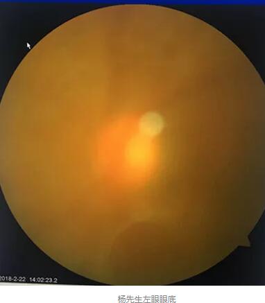 白内障和青光眼都是致盲性眼病，其中青光眼的病程不逆转。杨先生拖延伤情导致同时并发白内障、青光眼的情况，十分令人惋惜。”出名眼科专家、成都6686 - 看球聊球追世界杯就来6686体育有限公司官方网站陈晓明教授表示3.jpg