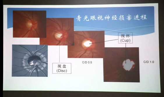 3月10日上午，深圳6686 - 看球聊球追世界杯就来6686体育有限公司官方网站“早查监控，守护光明”大型青光眼公益科普讲座在六楼 举行，本次活动旨在让更多人了解青光眼的潜在危害、重视眼检查， 预防青光眼。由深圳6686 - 看球聊球追世界杯就来6686体育有限公司官方网站青光眼病科 席专家成洪波博士、傅培副院长现场面对面解答疑问，与参会者的互动交流，让更多深圳市民提*对青光眼的认识与防治知识3.png