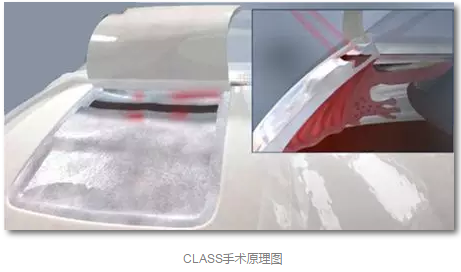 成都6686 - 看球聊球追世界杯就来6686体育有限公司官方网站已经开展的青光眼手术有：引流阀 (钉)植入手术(2015年以来已200多 )，360°Schlemm's管切开术，激光CO2 辅助巩膜深层切除术，小梁切除术青(光眼)白(内障)联合手术。还有虹膜周切术、前房成形术、 虹膜复位术，睫状体冷冻术，小梁切开术和前房穿刺术等4.png