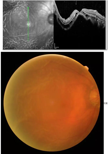 李老太在毫无征兆的情况下右眼视力下降至看不见东西。李老太家人带其至县医院就诊。医生诊断为视网膜脱离，需做玻切手术医治，而玻切手术需要动手术2次。怕疼的李老太一听就犯怵了：开刀，疼。 终，李老太的家人在多方打听后决定带李老太至宜昌6686 - 看球聊球追世界杯就来6686体育有限公司官方网站找许大玲院长医治1_副本.jpg