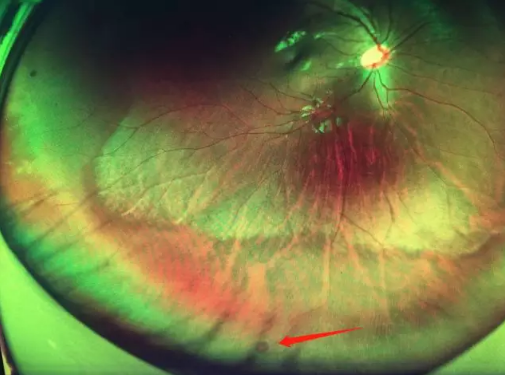 想要摘镜参军在深圳6686体育查出视网膜裂孔 细心妈妈挽救孩子视网膜1.png