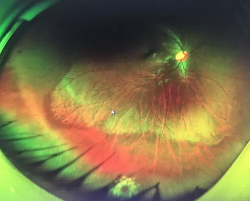 想要摘镜参军在深圳6686体育查出视网膜裂孔 细心妈妈挽救孩子视网膜2.png