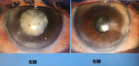 同时患 青光眼、白内障老婆婆辗转几家医院之后终于在成都6686体育顺利手术2.png