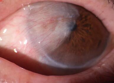 淮南胬肉手术一把刀——淮南6686 - 看球聊球追世界杯就来6686体育有限公司官方网站李建东院长采访记1.jpg