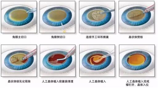 叶院长哪一种白内障手术 ，术后视觉 更好？.jpg