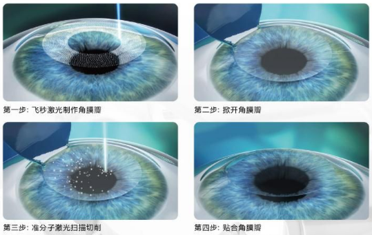 近视无法根治？但你可以这样做？6686体育“有爱就有希望”近视手术火热进行中5.png