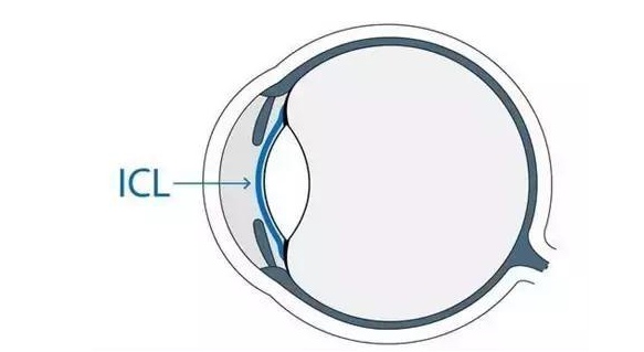 在杭州6686 - 看球聊球追世界杯就来6686体育有限公司官方网站高度近视手术后，近视2550度配不到眼镜的四川大哥，看清了！4.png