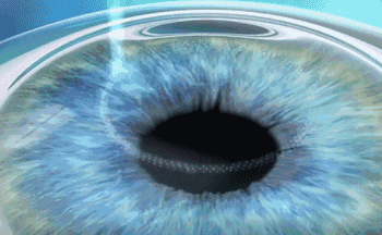 7月26日来深圳6686 - 看球聊球追世界杯就来6686体育有限公司官方网站参与暑期摘镜季活动就可以有机会参与抽奖免单手术！1.gif